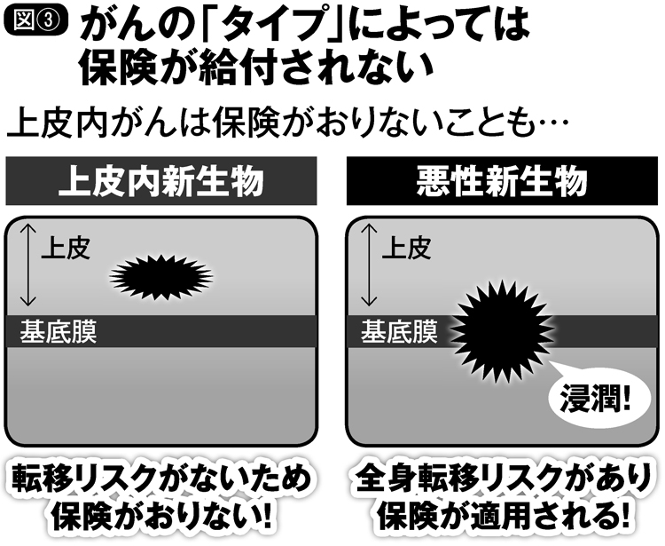 がんの「タイプ」によっては保険が給付されない