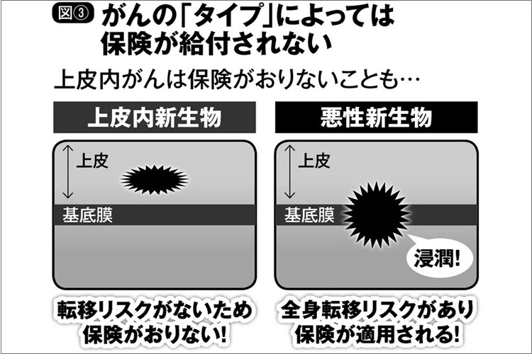 「がん」なのに「がん保険」が支払われないのはなぜか？