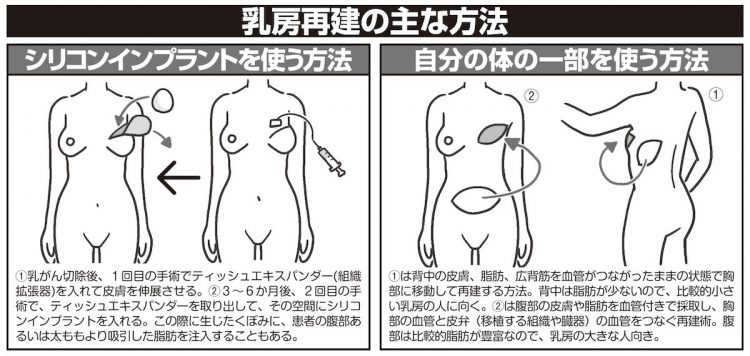 乳房再建の主な方法を図解