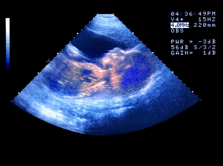 赤ちゃんの姿がわかるまで成長した妊娠6か月のエコー写真。高齢出産の場合、ここまで流産せずに育めないケースも多い（Getty Images）