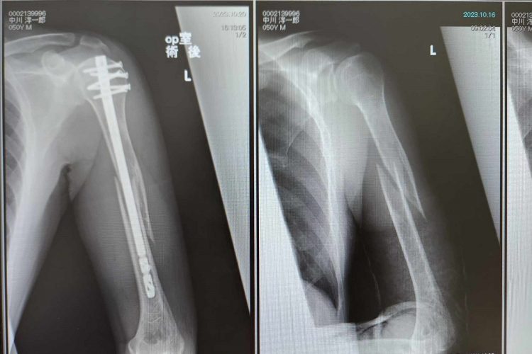 中川氏が骨折した時に撮影した左腕のレントゲン写真