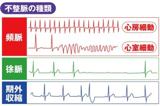 不整脈である「頻脈」「徐脈」「期外収縮」の心電図の波形
