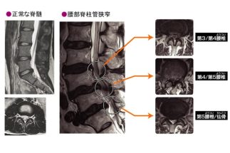 MRIの画像診断でも原因が特定しにくい「慢性腰痛」、痛みの感じ方には脳が深く関係　運動器の障害か精神医学的な要因か、見分ける検査方法とは【専門医が解説】