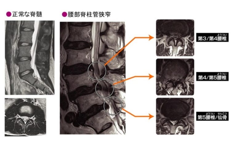 腰部脊柱管狭窄を起こしている神経（右）と正常な神経（左）