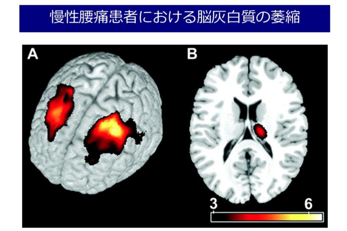 慢性腰痛患者の「萎縮した脳」は治療でもとに戻すことができる 治療の