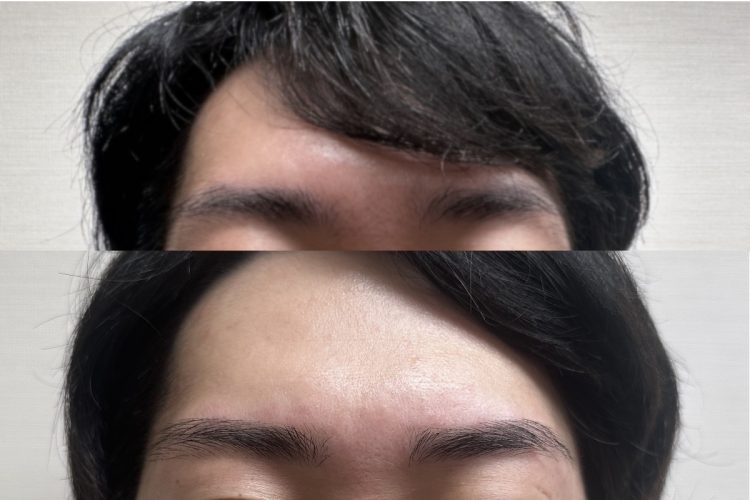 正面からのビフォーアフター