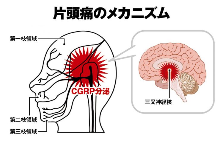 脳の三叉神経から神経伝達物質であるCGRPが過剰に産生されることをきっかけに、痛みが広がり増幅される