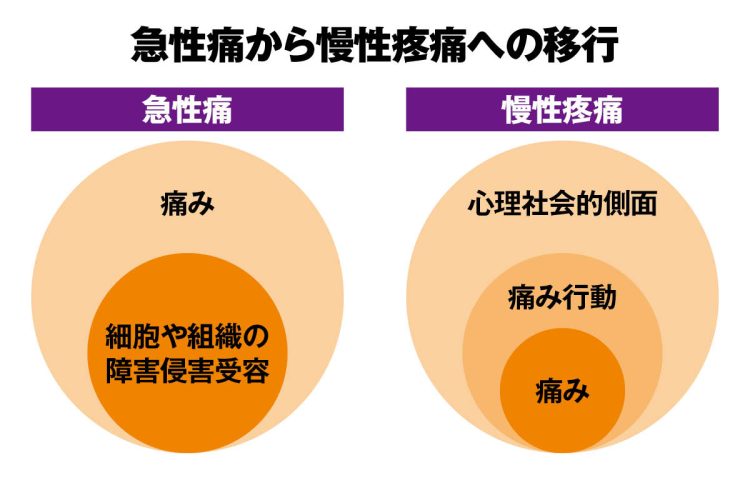 細胞や組織が傷ついて生じる急性痛に、神経障害や心理的・社会的な要因が絡み合うと、細胞や組織が回復しても痛みが残り慢性疼痛になる