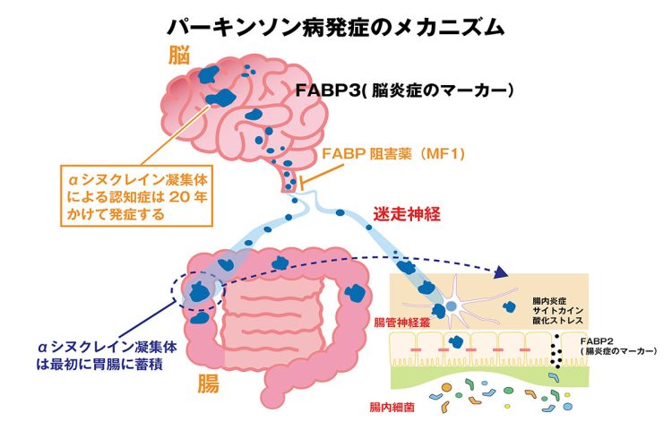 腸で悪玉腸内細菌が増加し、便秘によってFABP2の発現が増えαシヌクレインが凝集する。αシヌクレイン凝集体は迷走神経を介して中脳に伝播し、運動障害が発症する。放置すると大脳皮質に伝播し、認知症を発症する