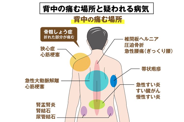 背中の痛む場所によって疑われる病気は異なる（高木元教授監修）