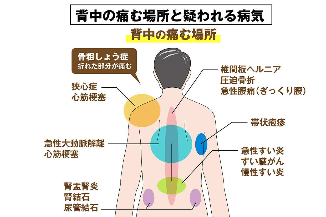 単なる筋肉痛”と決めつけてはいけない」ぎっくり腰・椎間板ヘルニア