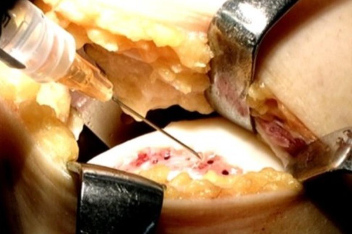 「モチジェル」を欠損部が周囲の軟骨と同じ高さになるまで注入する（内視鏡画像）