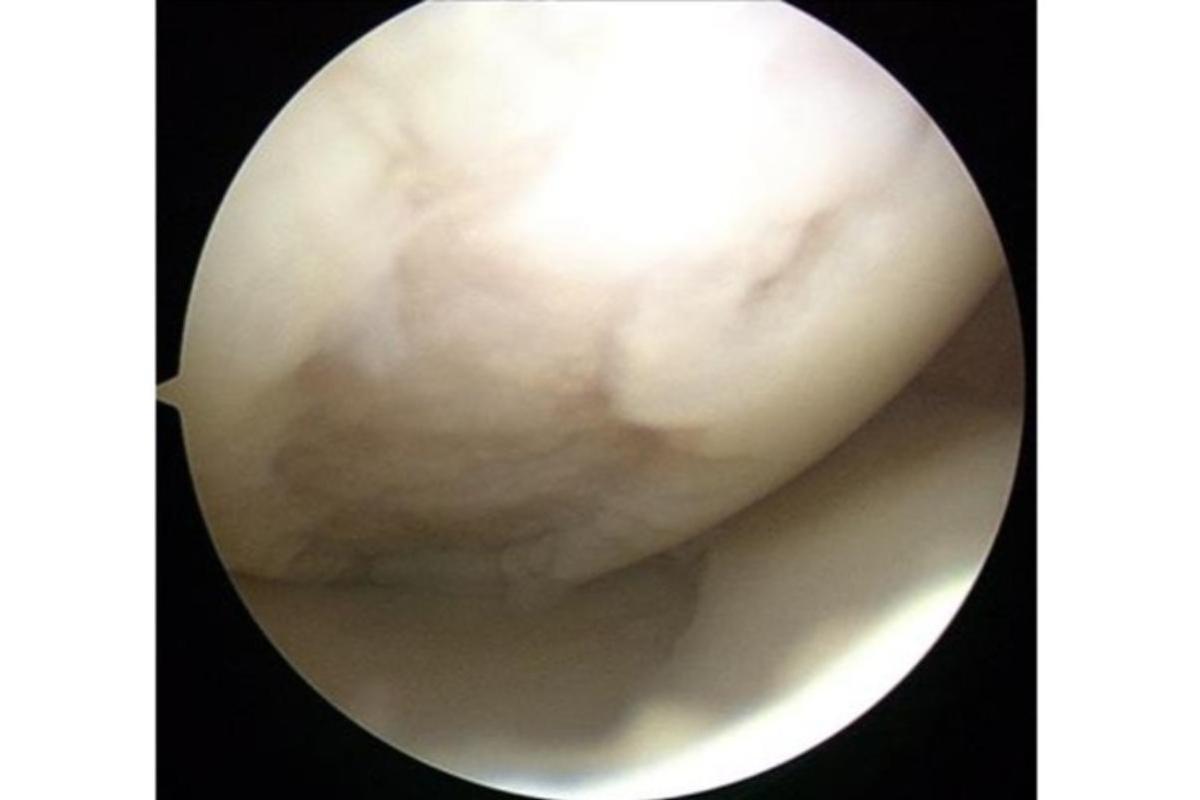 損傷した膝軟骨の内視鏡画像