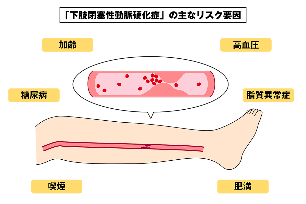 特に重要なリスク因子は「喫煙」「糖尿病」「加齢」