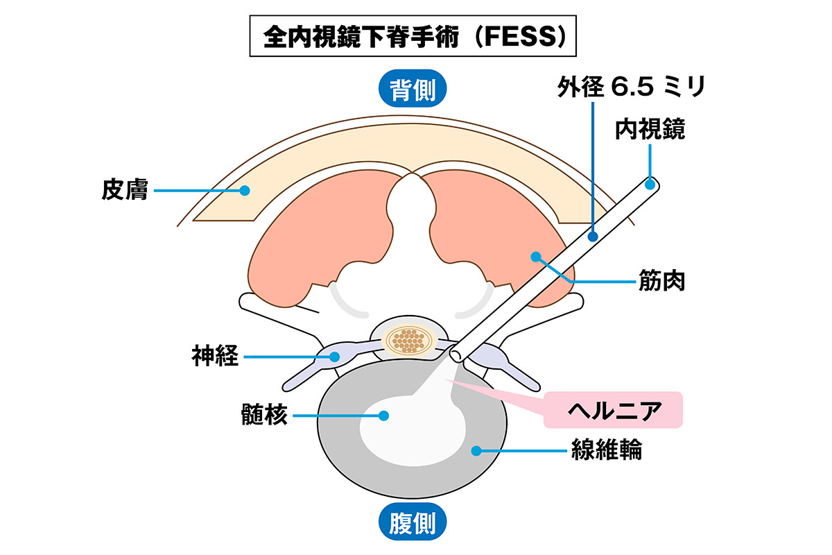 腰椎椎間板ヘルニアに対する全内視鏡下脊椎手術は「硬性内視鏡」と呼ばれる細い内視鏡を使用する。皮膚の切開は6~8ミリ程度が1か所で、手術後数時間で歩行可能となり、翌日には退院できることも
