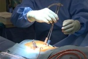 「Jプローブ」を使った「低侵襲腰椎後方椎体固定術(MIS-TLIF)」