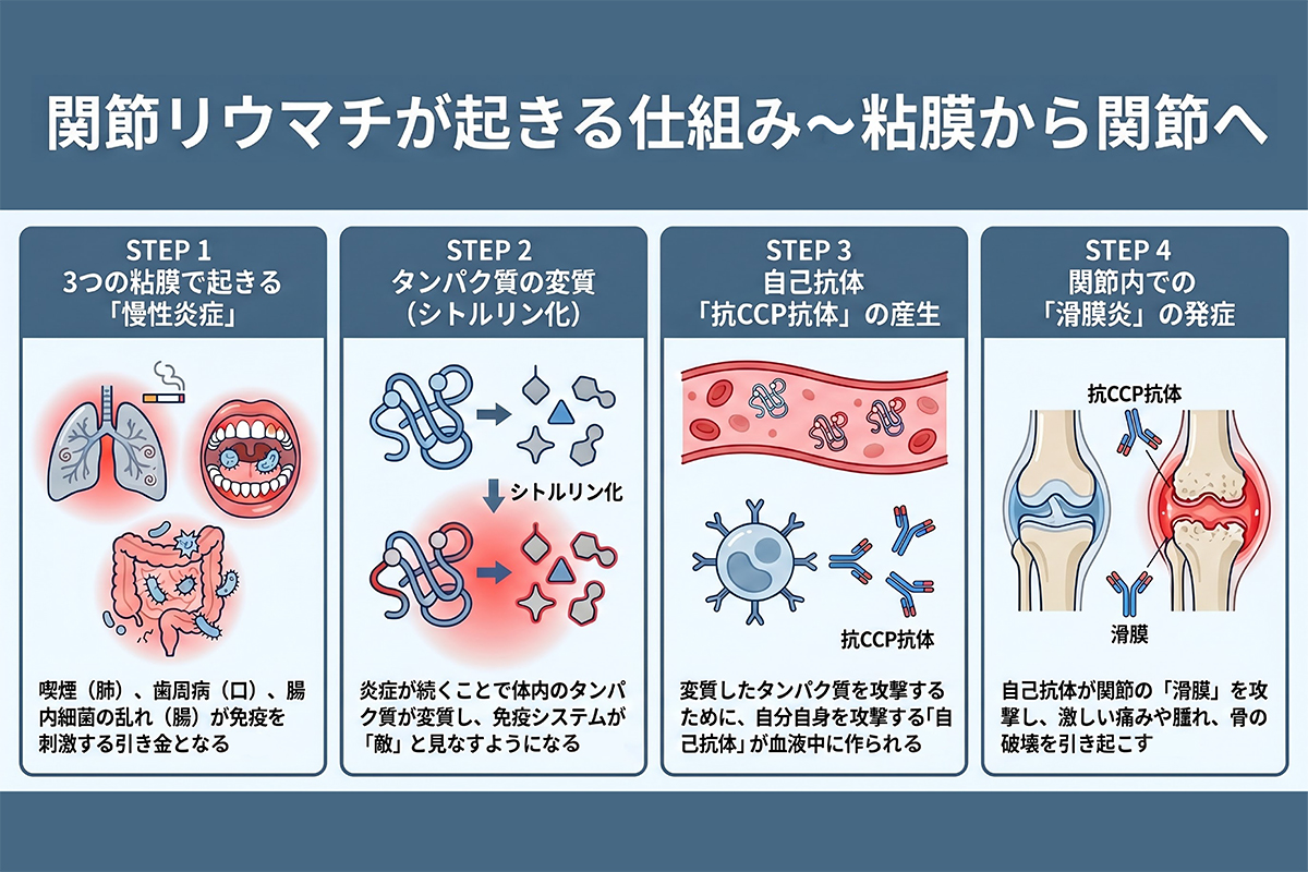 関節リウマチは粘膜での慢性炎症が「自己抗体」を作り出し、それが関節を攻撃することで発症する