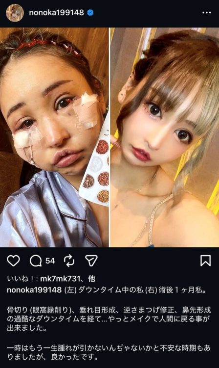 美容整形には様々なトラブルも（『ダウンタイム』にエキストラで出演した桜井野の花さん）