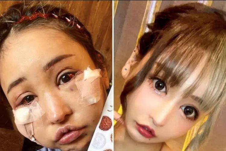 美容整形には様々なトラブルも（『ダウンタイム』にエキストラで出演した桜井野の花さん）